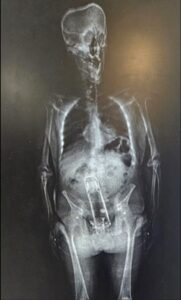 An image of Walter Frymire's prison body scan, showing a metallic object in a place where one would generally hope not to find a metallic object.